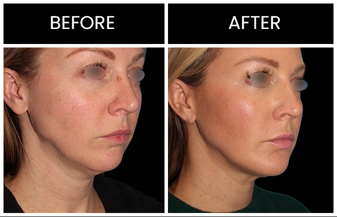 Chin Augmentation Results Atlanta